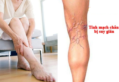 Cách điều trị suy giãn tĩnh mạch hiệu quả