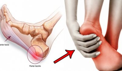 Hiện tượng Gai xương gót chân